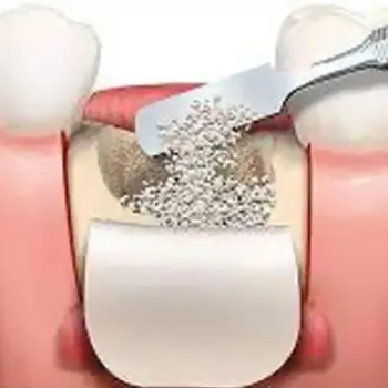 Bone Augmentation