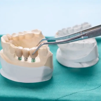 Implant Supported Dentures