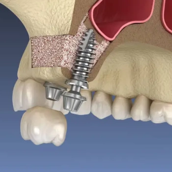 Sinus Lift