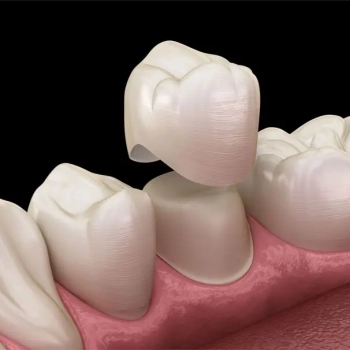 Dental Crowns