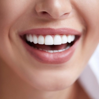 Porcelain Veneers